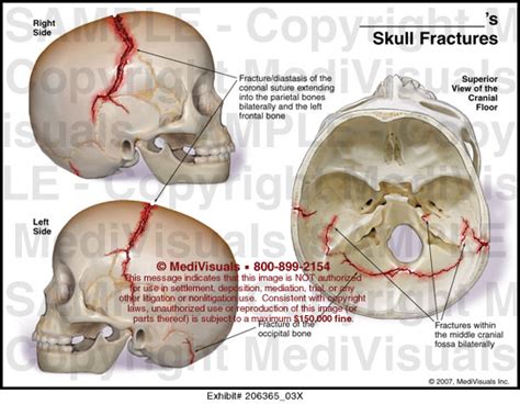 Medivisuals Skull Fractures Medical Illustration