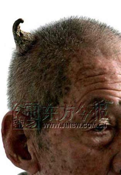 People Who Grow Real Horns 9 Pics