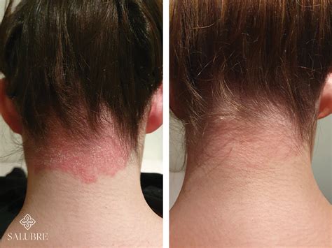 Psoriasis Before And After Treatment Salubre Skin Clinic Salubre
