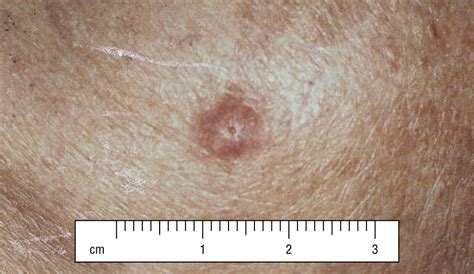 Merkel cell carcinoma, also called neuroendocrine cancer of the skin, is an aggressive type of skin cancer that affects only about 400 people in the united states each year. Merkel Cell Carcinoma of the Head and Neck: Effect of ...
