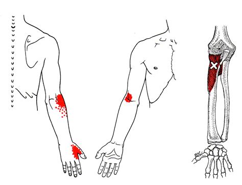 Supinatormuskel Unterarm The Trigger Point And Referred Pain Guide