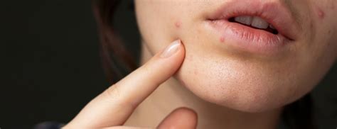 9 Ways To Manage Clogged Pores And Congested Skin Holland And Barrett