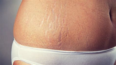 10 Home Remedies For Stretch Marks Removal Naturally Health Prime Tips