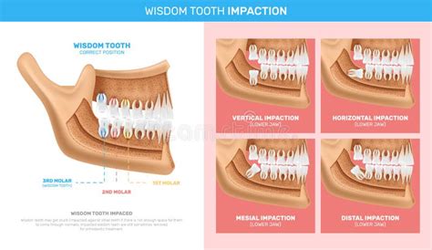 Wisdom Tooth Impaction Infographics Stock Vector Illustration Of Bone