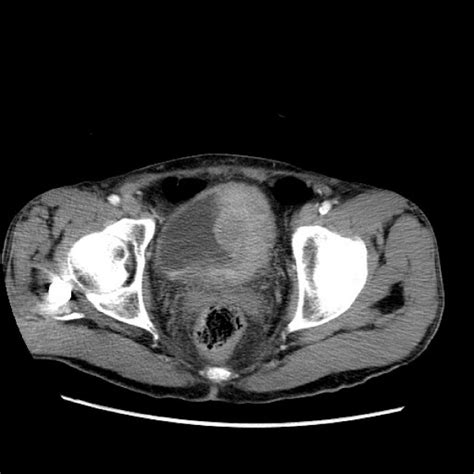 Ct Scan Of Case 1 Large Lobulated Enhancing Soft Tissue Mass