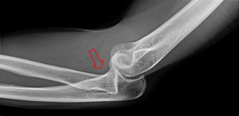 Anterior Vs Posterior Elbow Dislocation