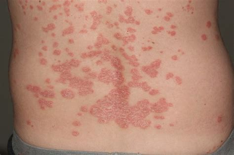 Check spelling or type a new query. dishydrose sois disant .... + boutons bras eczema ...