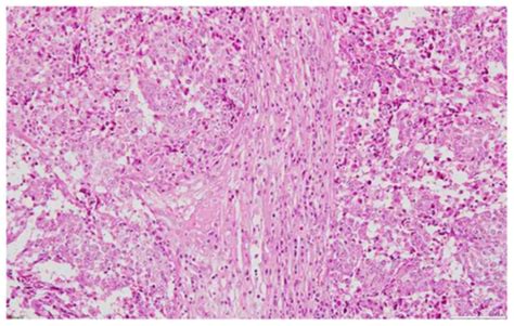 Carcinomatous‑like Mastitis Due To Axillary Lymphadenopathy In A Case