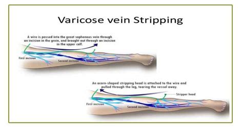 Difference Between Vein Stripping And The Procedures Cvr Does