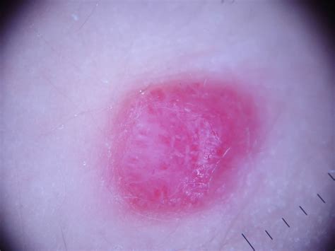 Virtual Grand Rounds In Dermatology 20 Atypical Spitz Nevus