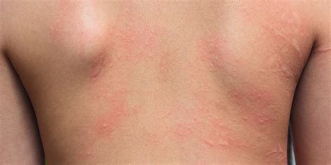 Allergic Contact Dermatitis Norris Dermatology And Laser Northwest Portland