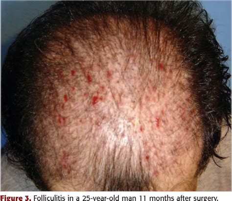 Aggregate 80 Hair Transplant Complications Latest In Eteachers