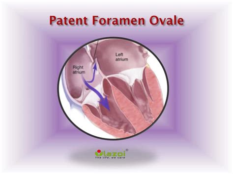 Ppt Patent Foramen Ovale Causes Symptoms Daignosis Prevention And