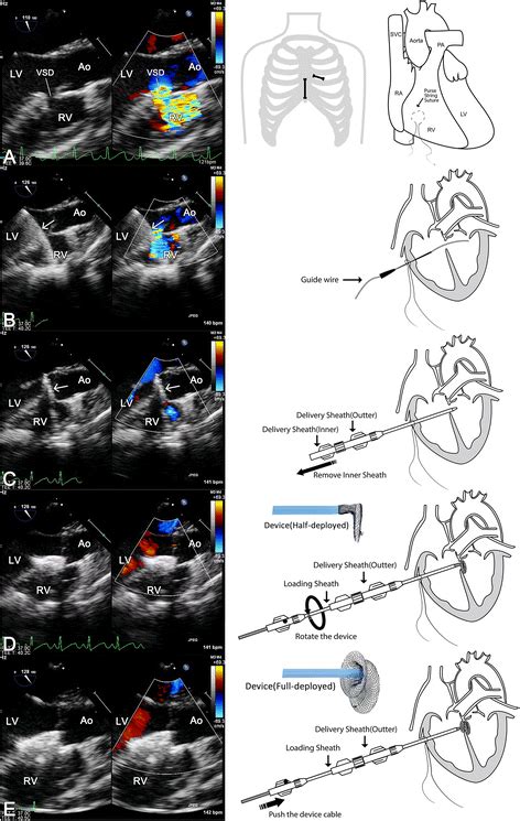 Minimally Invasive Perventricular Device Closure Of Doubly Committed