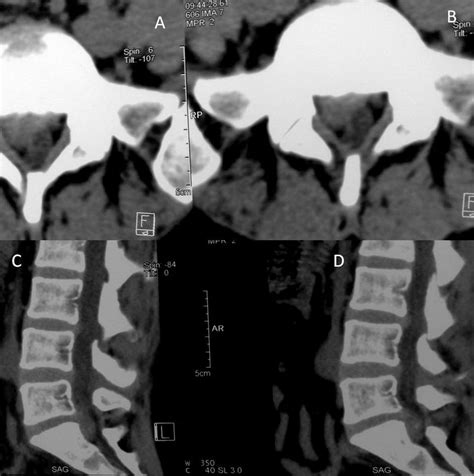Ct Scan Of Lumbar Axial A B And Sagittal C D View On The L5 S1