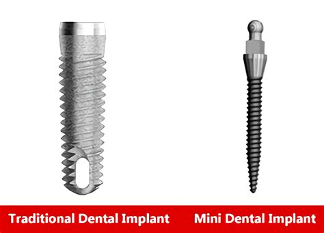 What Are Mini Dental Implants Its Benefits Indication
