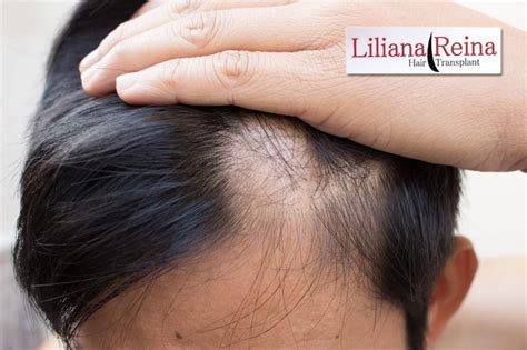 ¿cuáles Son Las Primeras Señales De Alopecia Dra Liliana Reina