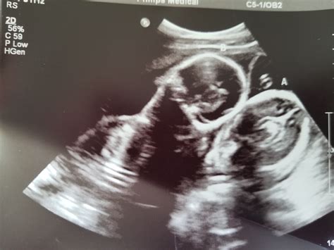 20 Weeks Pregnant Ultrasound Twins