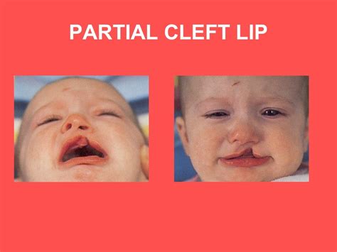 23 Introduction Cleft Lip And Palate