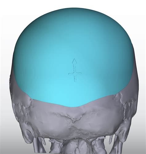 Custom Skull Implant For Flat Back Of The Head Back View Dr Barry