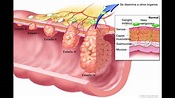 Detección precoz del cáncer de colon - Clínica Planas Blog