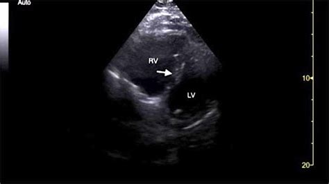 Cureus Serial Point Of Care Echocardiography Performed By An