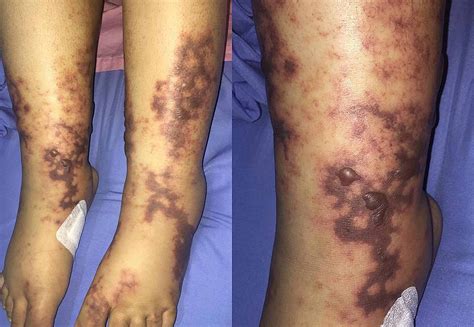 Cureus Peripheral Gangrene As The Initial Presentation Of Systemic