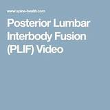 Posterior Lumbar Fusion Recovery Time