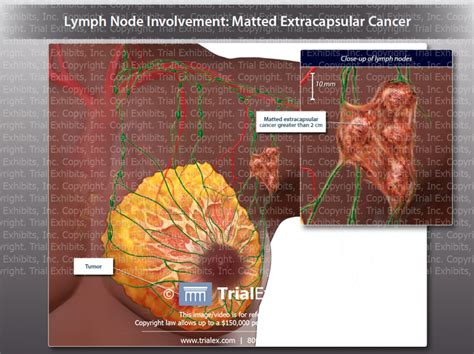 Lymph Node Involvement Matted Extracapsular Cancer Trialexhibits Inc