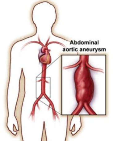 Aortic Aneurysm AAA Thoracic Aneurysm TAA AZ Vascular Specialists