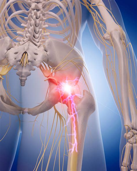 What Is Sciatica And How Do You Treat Sciatic Nerve Pain