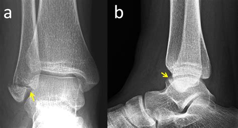 Cureus Isolated Lateral Malleolar Fracture Treated With A