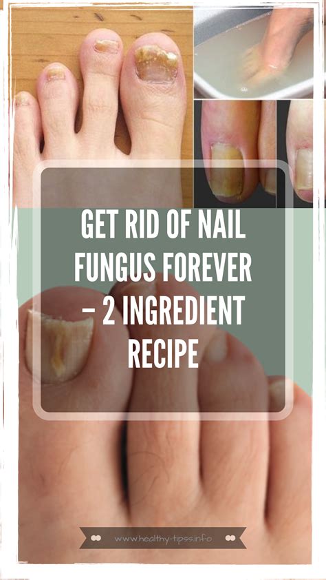 Get Rid Of Nail Fungus Forever 2 Ingredient Recipe Fungi