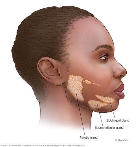 Submandibular Gland Swelling