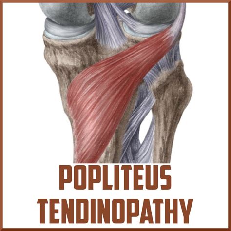 Popliteus Tendinopathy A Poorly Understood Cause Of Knee Pain Sports