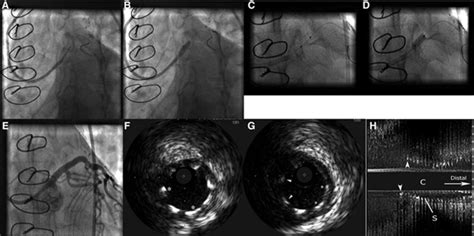 Mri Induced Stent Dislodgment Soon After Left Main Coronary Artery
