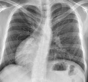 Heart can be normally located on the right side of the chest also and this condition is called dextrocardia. Dextrocardia chest x ray - wikidoc