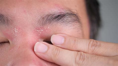 Psoriasis Around Eyes Symptoms Causes And Treatments