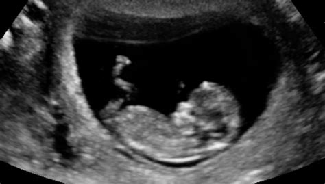 The ultrasound scan is very important in this period and brings a lot of information on the status of the embryo. My Pregnancy Journal...birth & beyond: 11 weeks, 4 days ...