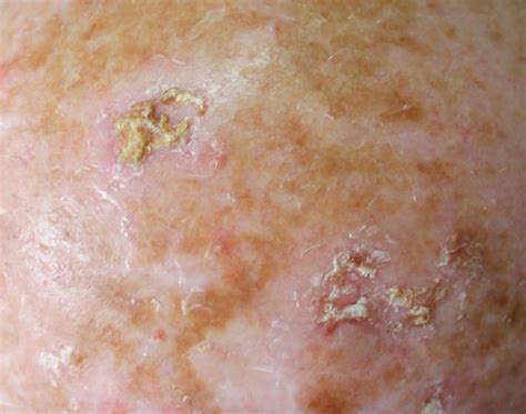 Invasive Cutaneous Squamous Cell Carcinoma Risk Increased In Actinic