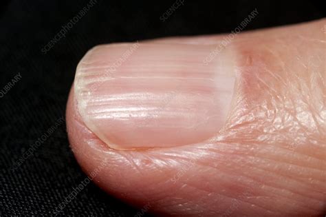 Ridged Fingernail In Psoriasis Stock Image C0142770 Science