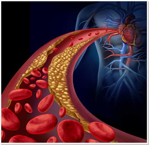 Conheça os sintomas mais comuns do enfarte agudo do miocárdio e saiba. Arquivos infarto agudo do miocárdio - Cirurgião Vascular ...