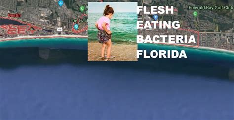 Young Indiana Girl Contracts Flesh Eating Bacteria While Visiting Florida Beach