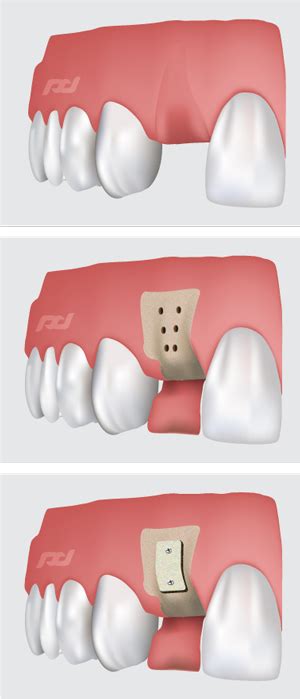 Bone Loss And Dental Implants Dentist In Jacksonville Nc