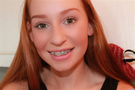 Pin On Girls With Braces 465