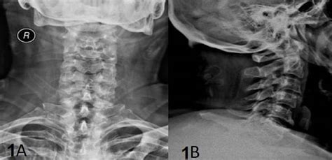 Differences Between A Normal Vs Abnormal Cervical Spine Mri Neck R