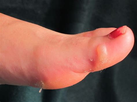 Blisters On Toes New Health Guide