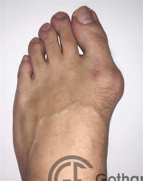 Before And After Bunion Surgery Procedures In New York Ny Gotham Footcare