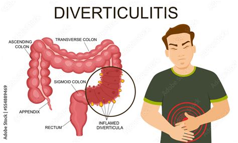 Diverticulitis And Diverticulosis Vector Illustration Medical