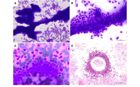 Fine Needle Aspiration Smears Of Metastatic Melanoma Are Shown A A Download Scientific